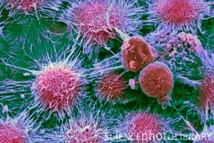 Kidney cancer cells, SEM